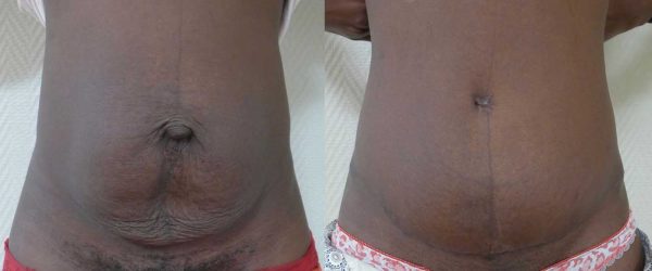 chirurgie paroi abdominale 8