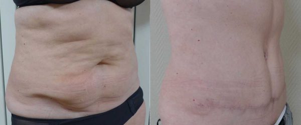 chirurgie paroi abdominale 9