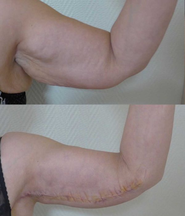 lifting bras dr coustal 1
