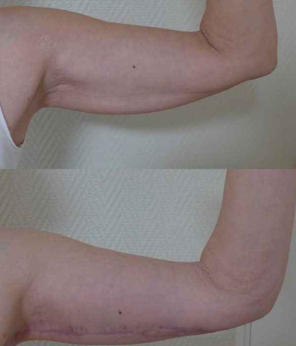 lifting bras dr coustal 3psd