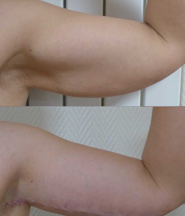 lifting bras dr coustal 4