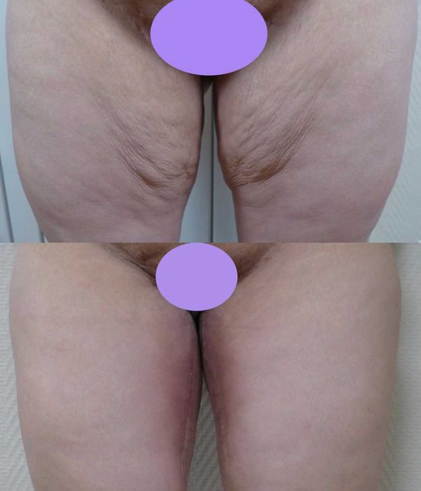 lifting cuisses dr coustal 1
