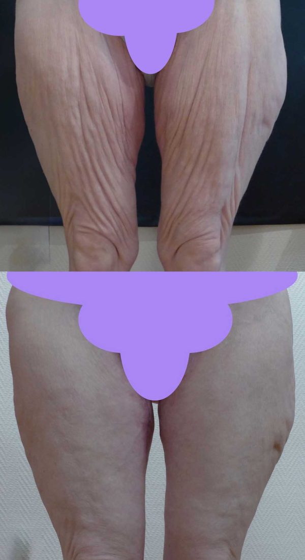 lifting cuisses dr coustal 2