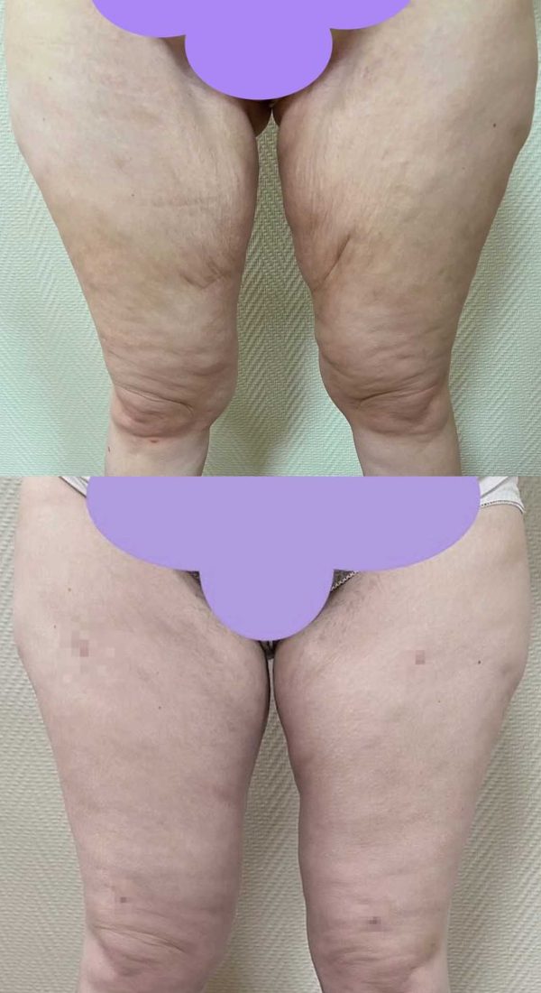 lifting cuisses dr coustal 3