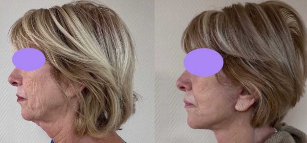 lifting facial 1