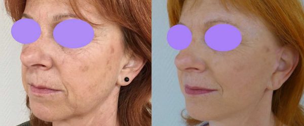 lifting facial 10