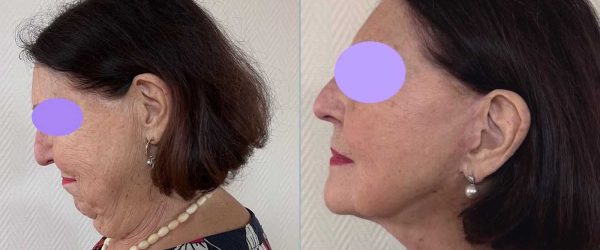lifting facial 11