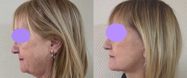 lifting facial 2