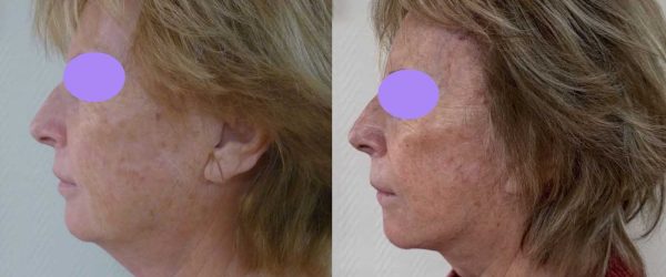 lifting facial 3