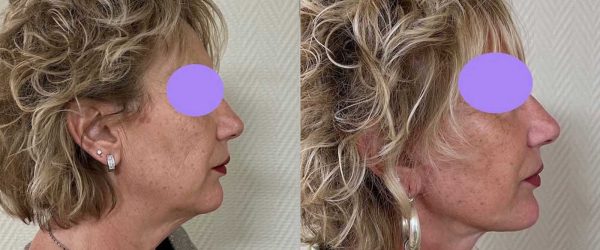 lifting facial 4