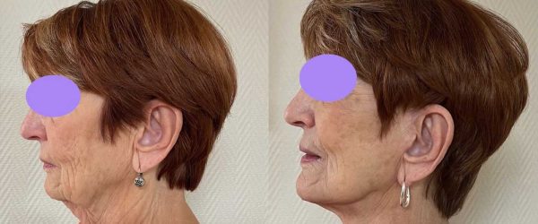 lifting facial 5