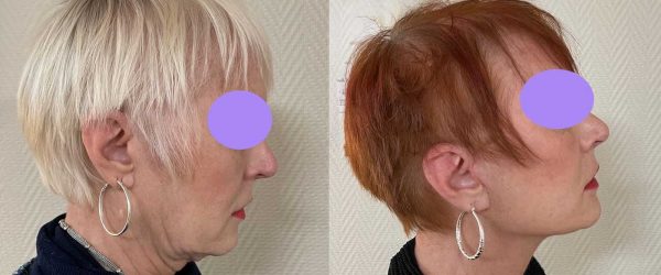 lifting facial 6