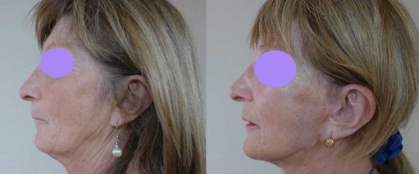 lifting facial 7