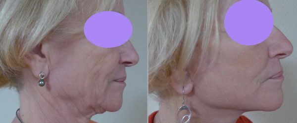 lifting facial 8