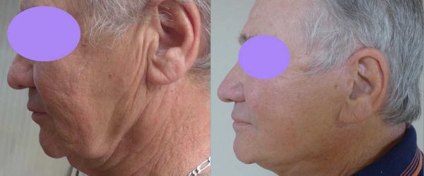 lifting facial 9