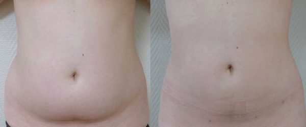 lipoaspiration Dr Coustal 1