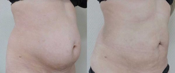 lipoaspiration Dr Coustal 2