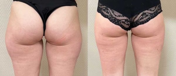 lipoaspiration Dr Coustal 3