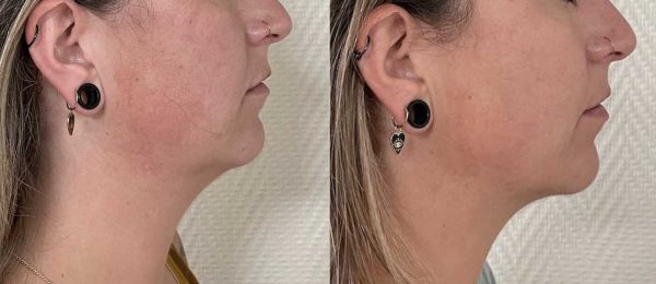 lipoaspiration Dr Coustal 4