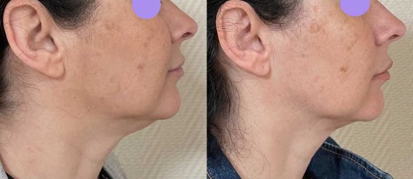 lipoaspiration Dr Coustal 5