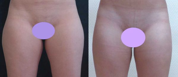 lipoaspiration Dr Coustal 6