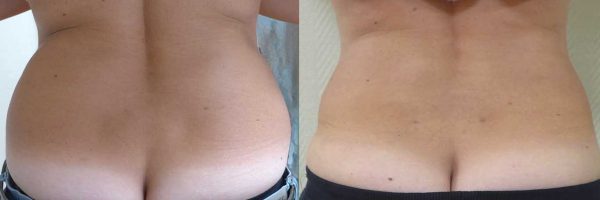 lipoaspiration Dr Coustal 7