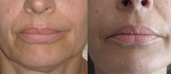 lipostructure bouche