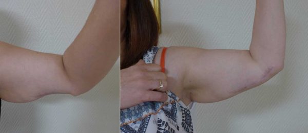 lipostructure bras