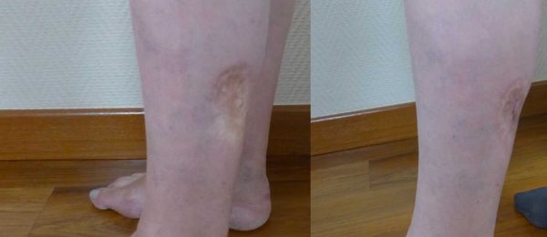 lipostructure jambes