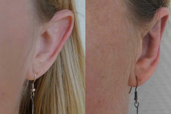 otoplastie dr coustal 1