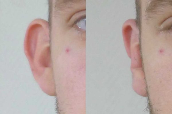 otoplastie dr coustal 2