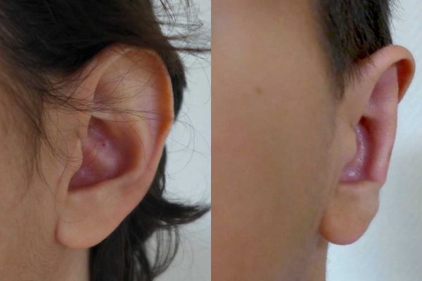 otoplastie dr coustal 4