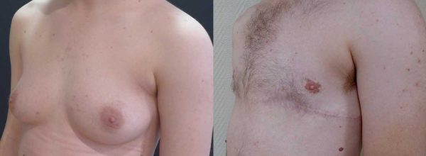 thoracoplastie 1