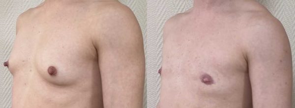 thoracoplastie 10