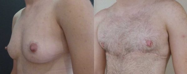 thoracoplastie 2