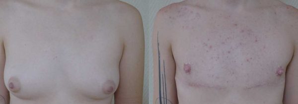 thoracoplastie 3