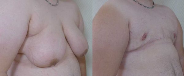 thoracoplastie 4
