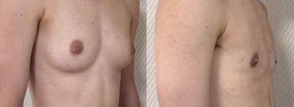 thoracoplastie 7