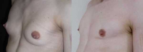 thoracoplastie 8