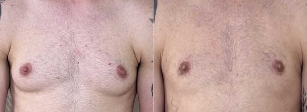 thoracoplastie 9